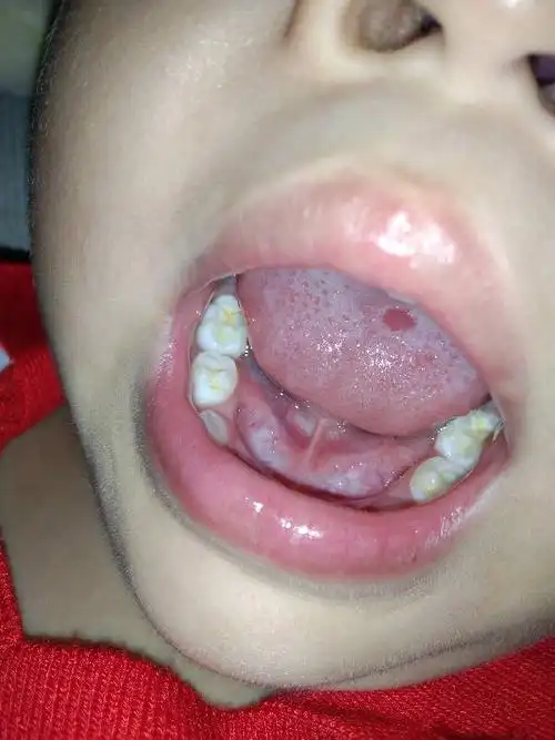 小孩2岁半,舌头上有个红色的点