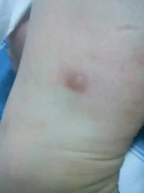 去年腿上长了一个这个硬疙瘩 不痛不痒 就是硬硬的凸起 今年另一个腿