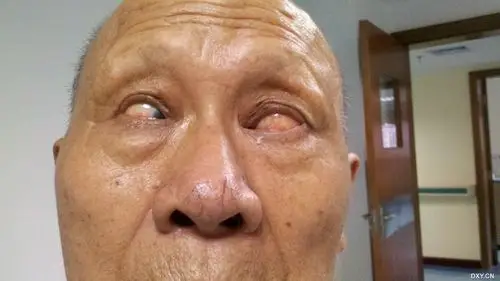 【分享】固定性内斜视