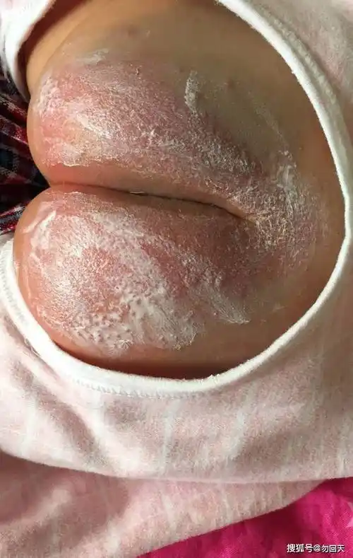 如何治疗尿布疹?如何预防呢_妈妈_宝宝_婴儿