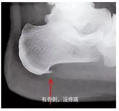 脚后跟痛真的是长骨刺了吗
