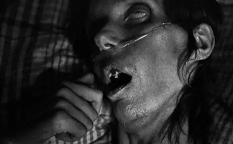 艾滋病怎么判断晚期,晚期还有的治