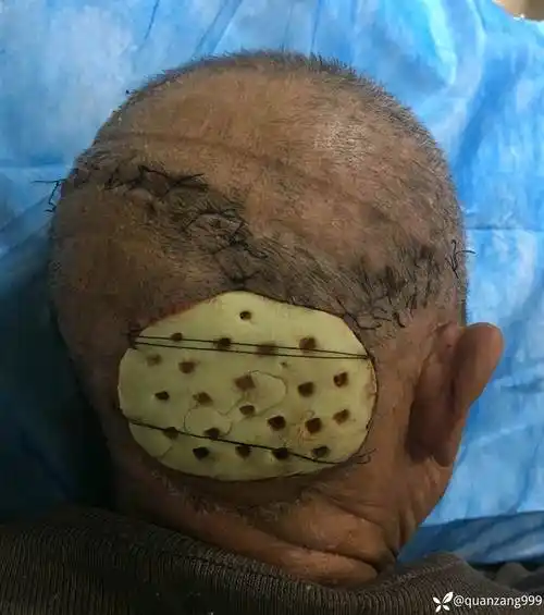 只做清创病人自愈的糖尿病相关创面来了时间治愈一切