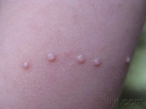 传染性软疣盼有效痛苦小的治疗方法