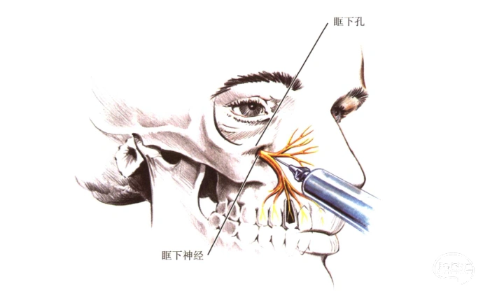 颏神经阻滞应用解剖颏孔通常位于下颌第二前磨牙根下方,下颌体上,下缘