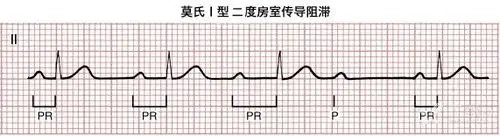 二 度房室传导阻滞 1.