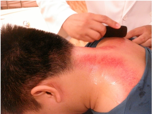 脖子处刮痧后出现紫色斑什么原因