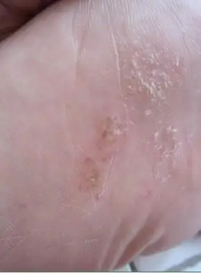 脚底起小水泡(有图),请专家指导