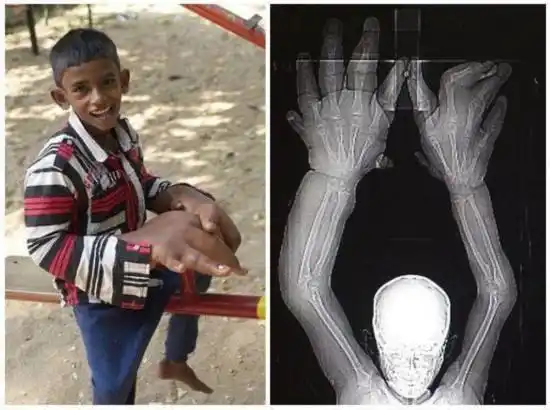 其实他和世界上手指脚趾最多的人一样,都是因为疾病或者遗传导致手掌