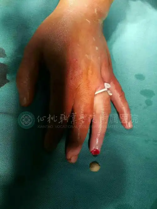 【2017年8月6日】女,40岁,左环指指尖部分离断清创探查回植术