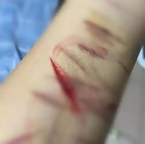 分手后自残的图片(分手后自残的图片真实高清)-情感知识库-动动脑