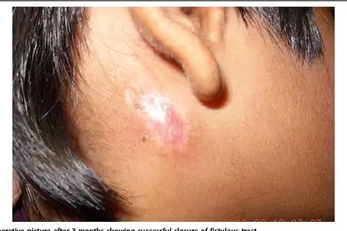 parotid fistula secondary to suppurative parotitis in a 13-year