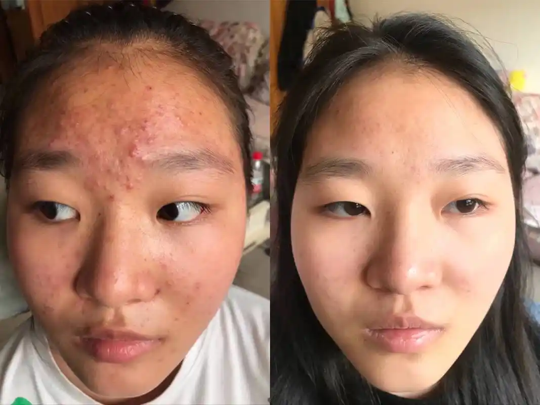 脸上痤疮用药前后脸上长痤疮怎么办?
