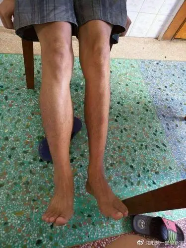 肌肉萎缩早期有哪些症状