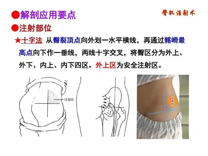 臀肌注射的解剖基础