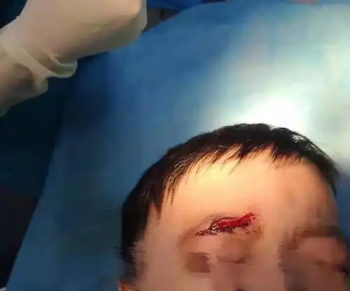 4岁娃在幼儿园把头上摔了4.5厘米长口子