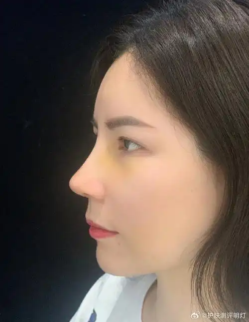 图一和图二是我刚拆完线时的鼻子照片,我觉得这个鼻型非常符合我的