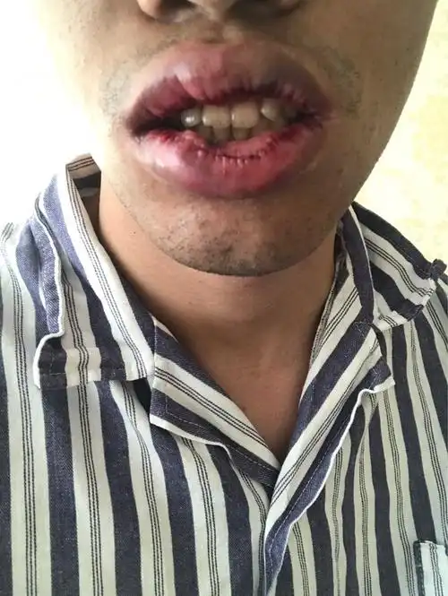 我的嘴巴本身龅牙凸嘴,嘴唇肥厚外翻挺严重的,院长和_圈子-新氧美容