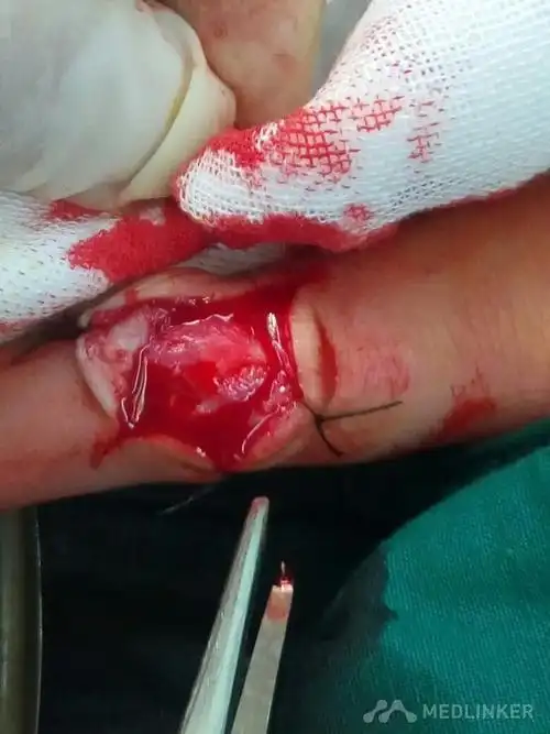 食指刀割伤伸肌腱断裂一例-医联