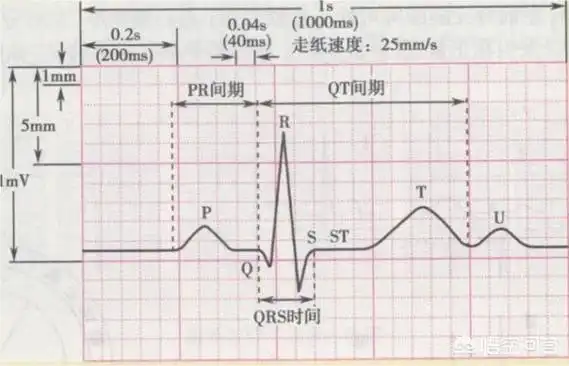 一个正常的心电周期波形由p波,qrs波,t波和u波四个波型组成.