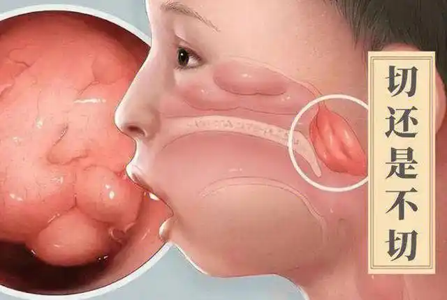 儿童腺样体肥大症状与危害