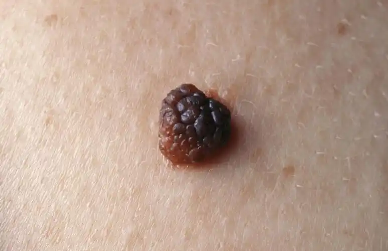 女子腹部疼痛难忍就医确诊宫颈癌晚期医生叹息来的太晚了