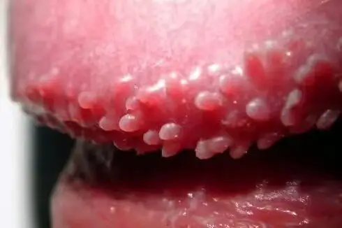 丁丁上常见的红色痘痘是什么鬼? - 好大夫在线