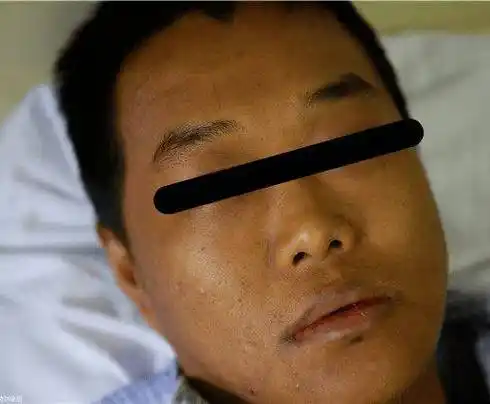 肝癌一查就晚期头部出现4个异常一定要引起注意