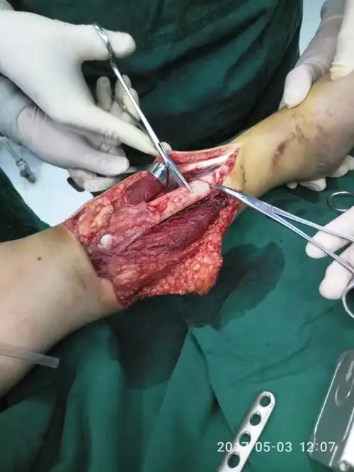 【襄垣县人民医院】我院骨科成功抢救一例左胫腓骨开放性骨折伴皮肤