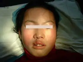 唇腭裂图片