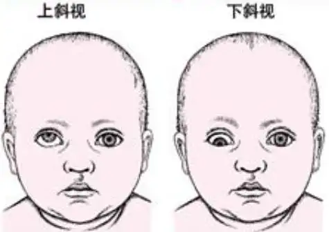 孩子弱视,如何进行