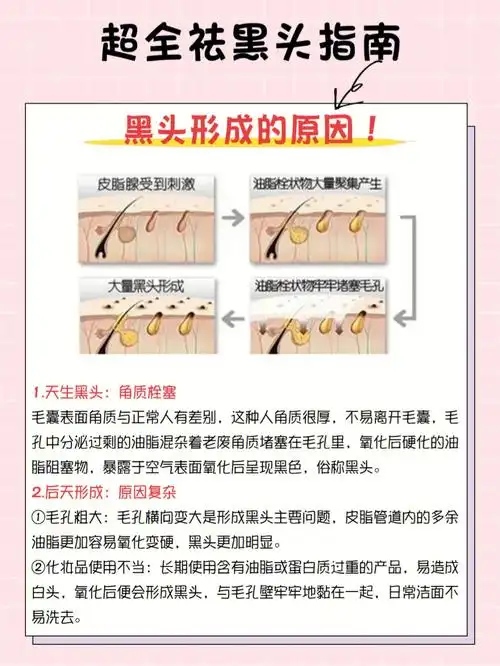 祛黑头最有效的三种方法60