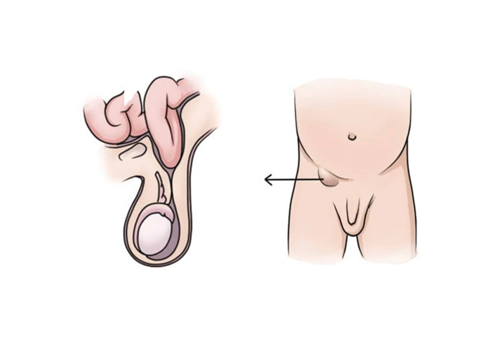 家有男宝宝容易得这三种病你要格外注意