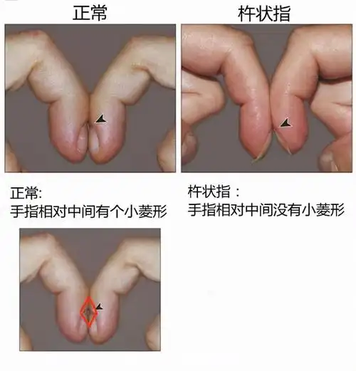 一试便知你是不是杵状指:不确定时,就伸出两根手指试一下吧!