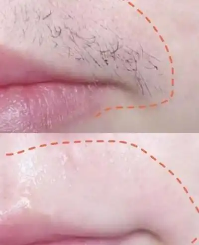 拔掉女生的小胡子很尴尬,该怎么去除唇毛?