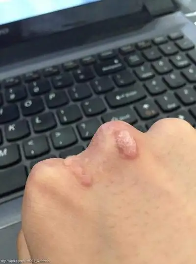 扁平疣图片_扁平疣症状表现图片大全_有来医生