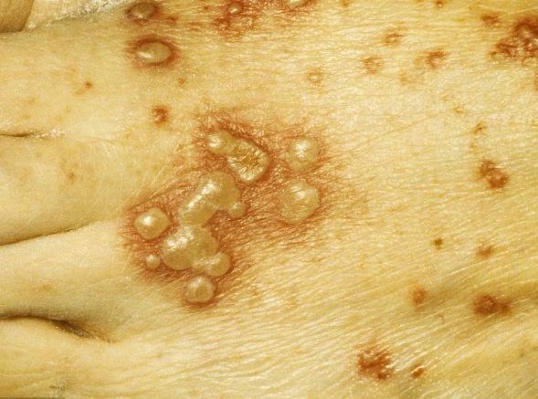 生带状疱疹吃什么药最好