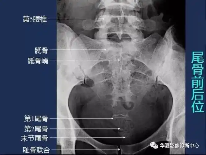 com | 71520.com尾骨侧位x线解剖图谱(尾骨)