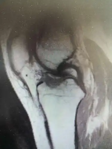 核磁发现胫骨髁间嵴撕脱骨折并移位.