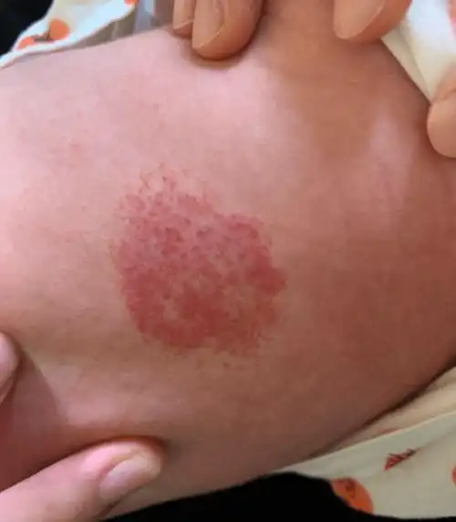 大部分血管瘤发病于皮肤,皮下组织等相对表浅的部位,一般在婴儿出生1