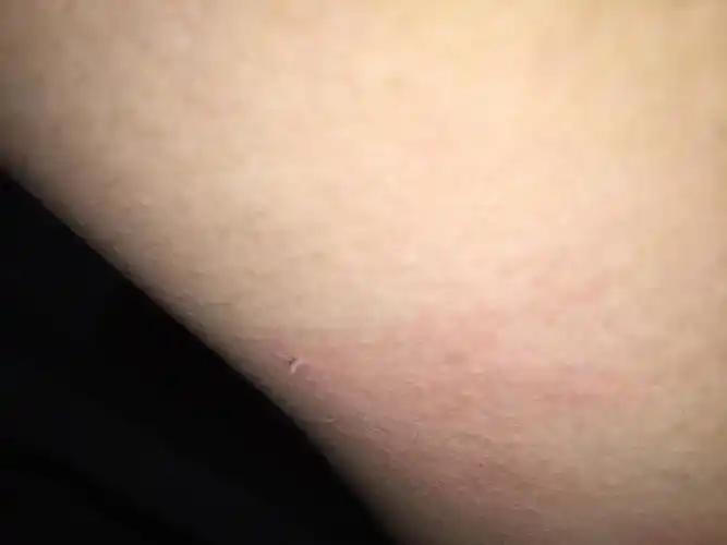 因为丝状疣属于一种病毒性感染,为了抑制丝状疣不断生长,可以多吃一些