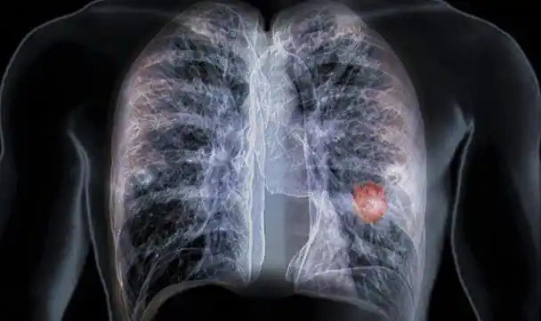 肺结核患者老年人占比逐年增高 且患者病"不知所起"-文交所资讯网