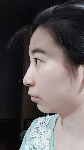 注册领红包      评论 表情 图片  提 交  相关评论 下巴后缩好修复的