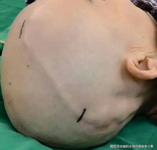 脑积水治疗难题最根本的就是脑积水分流的感染和堵管并发症