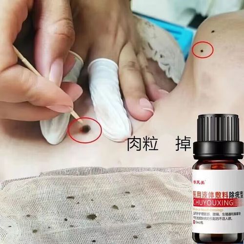 克疣液疣瘊膏医用尖锐克疣液凝露喷剂洗剂膏丝状疣寻常瘊私处可用