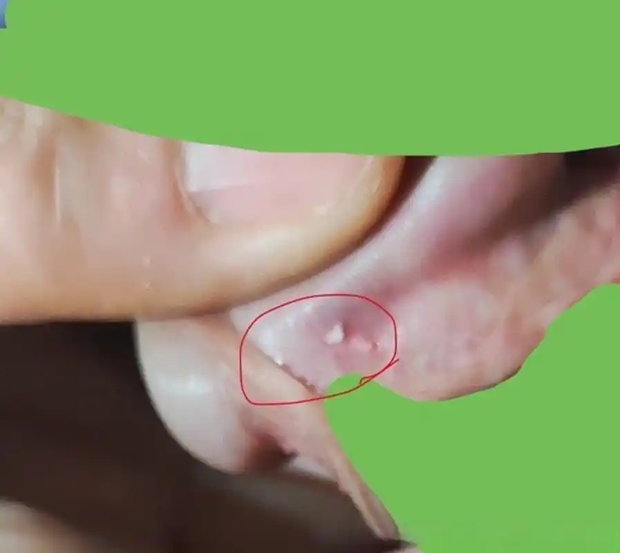 阴茎龟头凹槽里面起了两个很硬的小疙瘩,不疼,摸上去特别硬.