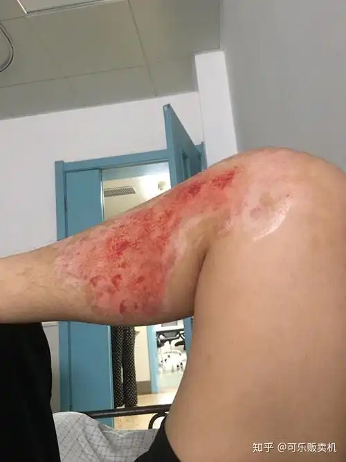 浅二度到深二度烧伤恢复过程记录有图慎点