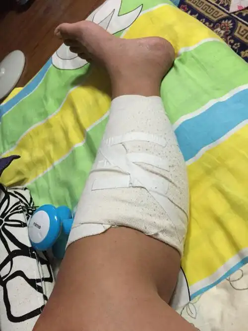 我小腿肚子因打篮球腓肠肌撕裂已经躺了20天了,现在不怎么疼了,可还是