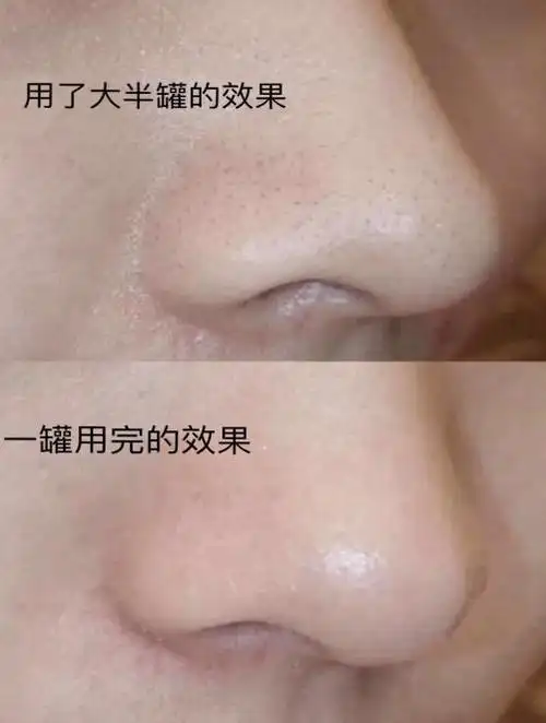 鼻子上黑头很严重毛孔粗大怎么办