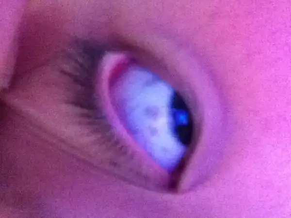 图为:小儿蛔虫病眼白蓝斑点